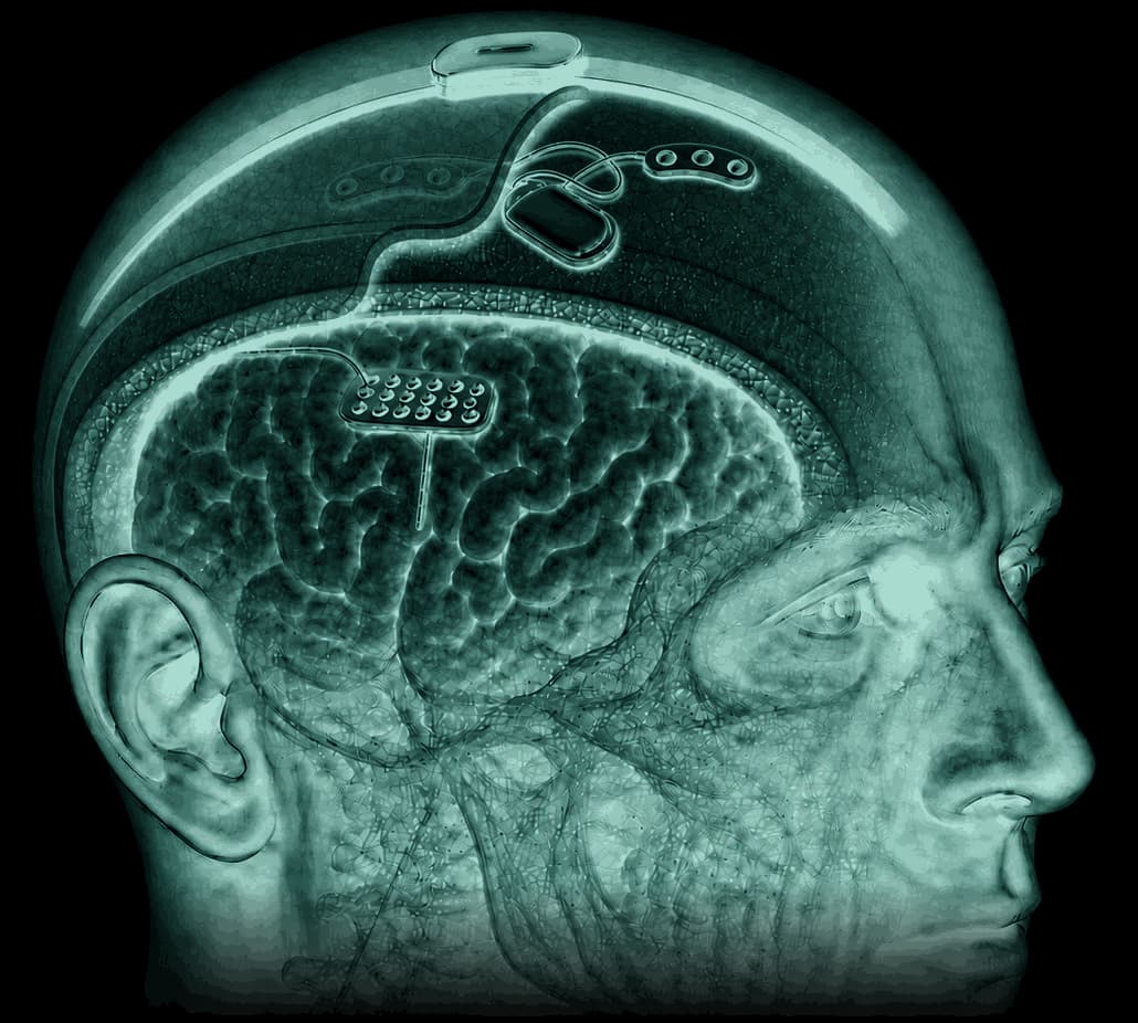 Anatomical illustration of a head with the skull cut away: a wearable headband on the scalp, a sub-scalp implant on the skull beneath the scalp, and an electrode grid on the brain.